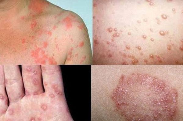 Bệnh lậu là gì? Triệu chứng của bệnh lậu và cách điều trị