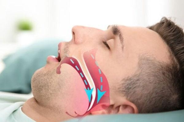 Hướng dẫn bạn 3 cách điều trị chứng ngừng thở khi ngủ