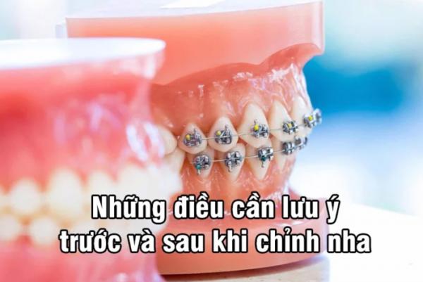Những điều cần lưu ý trước và sau khi tiến hành niềng răng