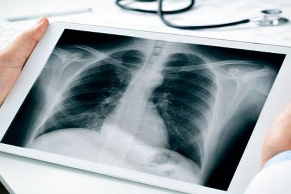 Những tác hại và khuyến cáo của Bộ Y tế về việc chụp X-quang đối với mọi người