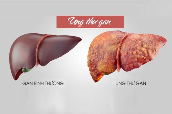 Ung thư gan là gì? 6+ dấu hiệu cảnh báo đầu tiên khi mắc bệnh