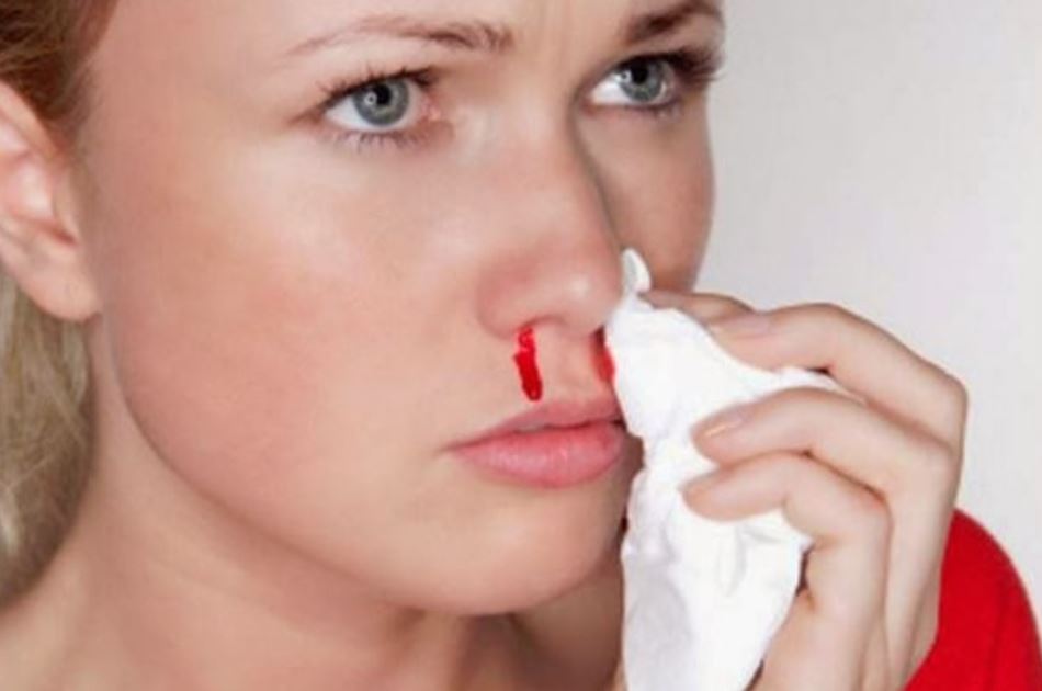 Để điều trị được tình trạng chảy máu cam ở người lớn, bạn cần phải quan tâm đến các bước sơ cứu ban đầu và lưu ý bị chảy máu