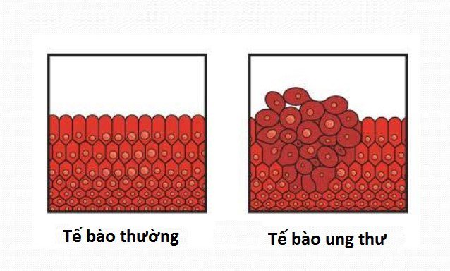Hình ảnh so sánh các tế bào bình thường và tế bào ung thư