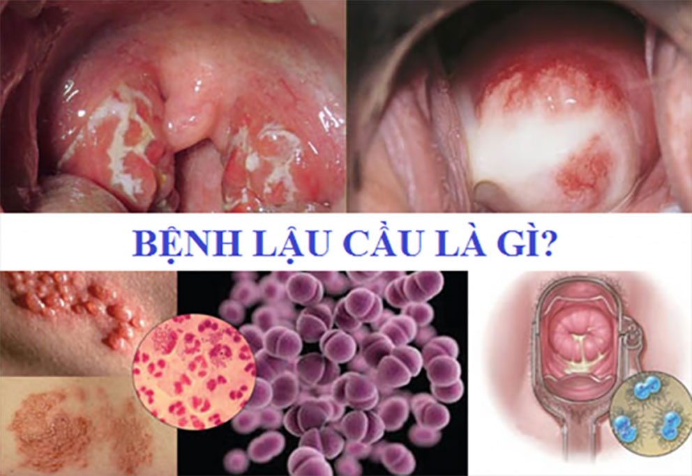 Bệnh lậu là gì? Triệu chứng của bệnh lậu và cách điều trị