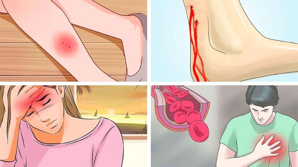 Cách sơ cứu đúng khi rắn độc cắn
