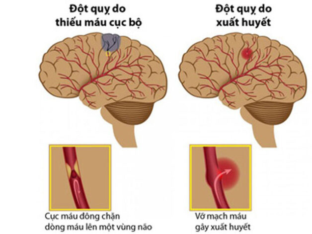 Cách phòng tránh đột quỵ