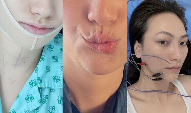 Cô nàng Phương Anh Đào gây bất ngờ khi tiết lộ việc cô trải qua mổ tuyến giáp và còn bị di chứng lệch méo khuôn môi