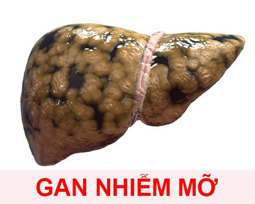Hầu hết, căn bệnh gan nhiễm mỡ không có triệu chứng mà chỉ phát hiện ra khi đi khám bác sĩ