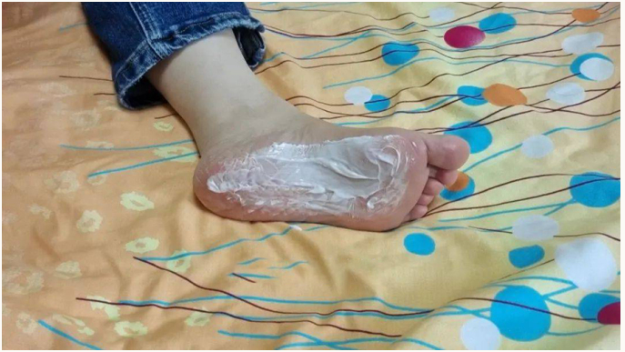 Giảm mồ hôi chân bằng kem đánh răng